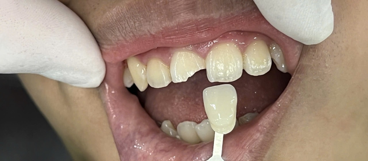 V007/VENEER:PHỤC HỒI HÌNH DÁNG RĂNG GÃY MẺ,ĐIỀU TRỊ XÂM LẤN TỐI THIỂU