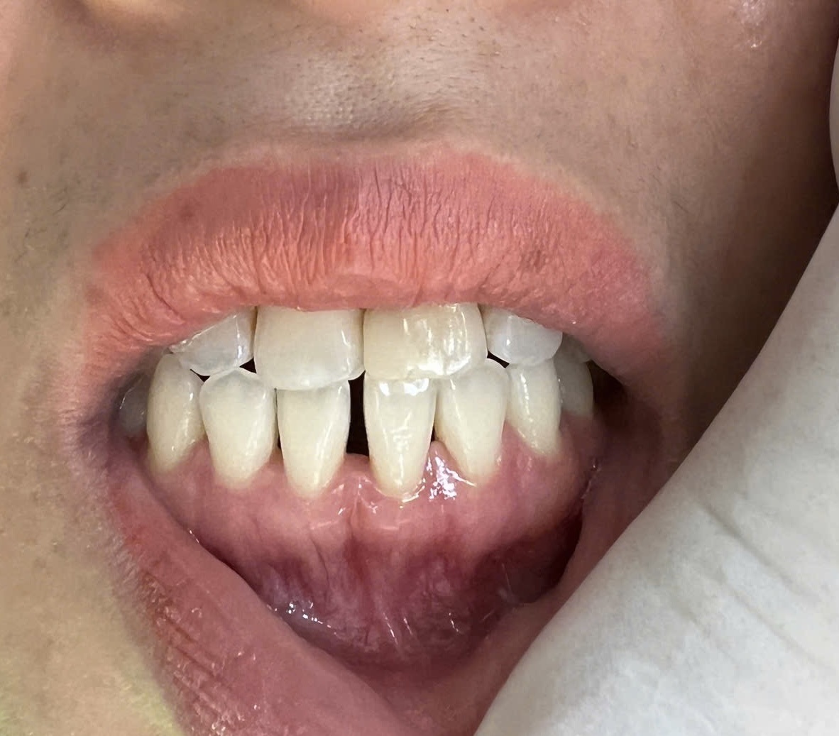 V009/VENEER:LẤP KHOẢNG HỞ GIỮA CÁC RĂNG CỬA /ĐIỀU TRỊ KHÔNG MÀI RĂNG-XÂM LẤN TỐI THIỂU