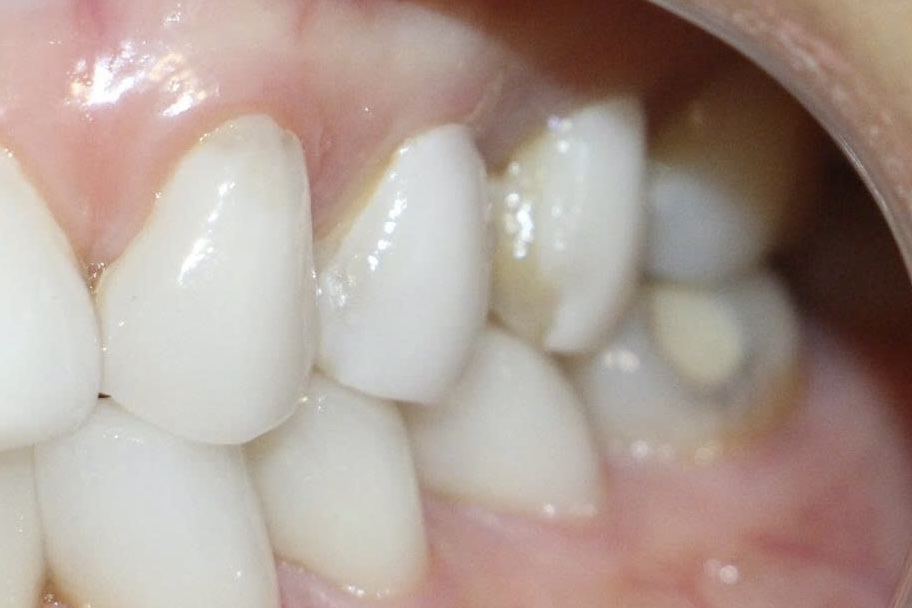 V016/VENEER:VENEER GÃY BỂ TRONG QUÁ TRÌNH SỬ DỤNG/GIÁ TRỊ CỦA THẨM MỸ XÂM LẤN TỐI THIỂU