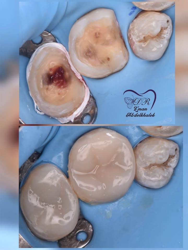 Ca Inlay / Onlay: phục hồi răng hàm (ca minh họa)