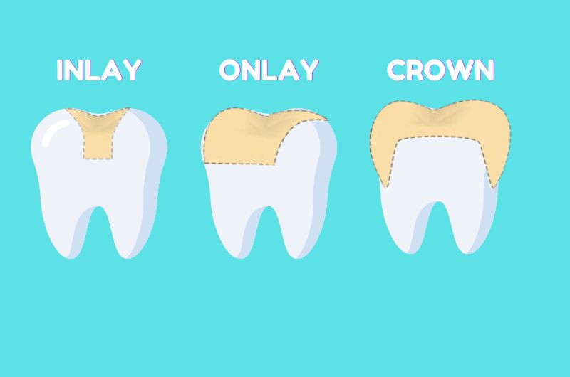 Nha khoa xâm lấn tối thiểu là gì? Vì sao đây là xu hướng của nha khoa hiện đại?