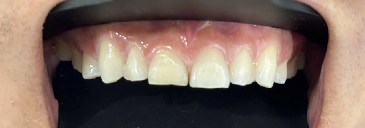 V003/VENEER:MÀU SẮC KHÔNG ĐỒNG ĐỀU,CAI THIỆN HÌNH DÁNG RĂNG